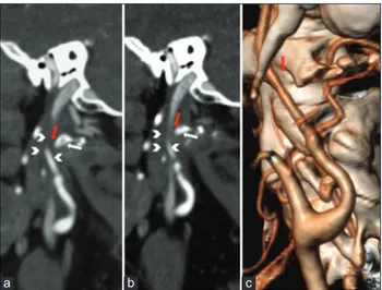 Figure  2: Postoperative computed tomography angiography  examination. (a and b) Sagittal multiplanar reconstruction  demonstrating the surgically generated distance (red arrows)  between the reshaped C1 transverse process (white arrows) and  internal caro
