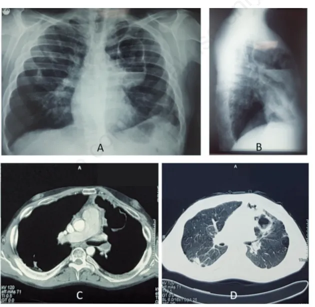 Figure 1. A,B) Posteroanterior and lateral chest x-ray at presentation showed the presence of a cavitated mass (10 cm of diameter) located in the upper left lobe with a frank air-fluid level