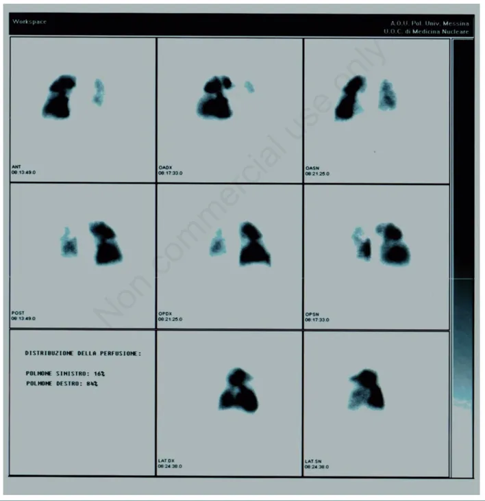 Figure 2. Lung perfusion scintigraphy. There are many perfusion defects in both lungs, partly consistent with the previous atypical resec- resec-tion of the upper left lobe and in other points strongly suggestive of their embolic nature.