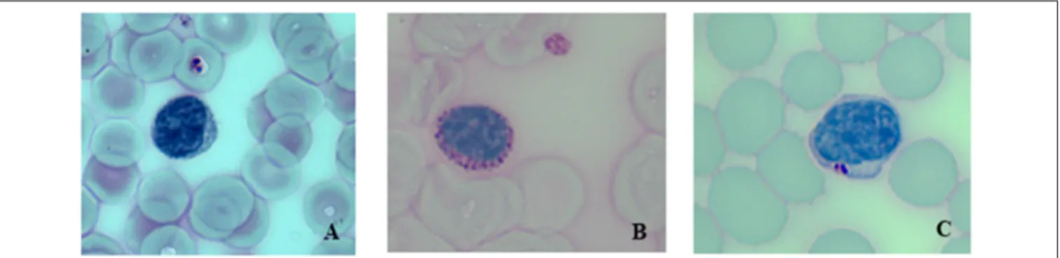 FIGURE 1 | Periodic acid-Schiff (PAS)-stained blood smear at 40 X magnification. (A) Healthy control, (B) Untreated LOPD patient showing a lymphocyte with a larger number of PAS-positive inclusions, (C) Same LOPD patient after 6 months of ERT.