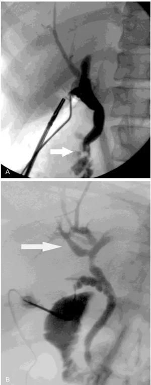 Figure 1. A: Intraoperative cholangiography showing  common bile duct stones (white arrow); B:  Anatomi-cal variation of the biliary tree at level of the right  he-patic duct (merger failure between the right posterior  and the right anterior segmental bra