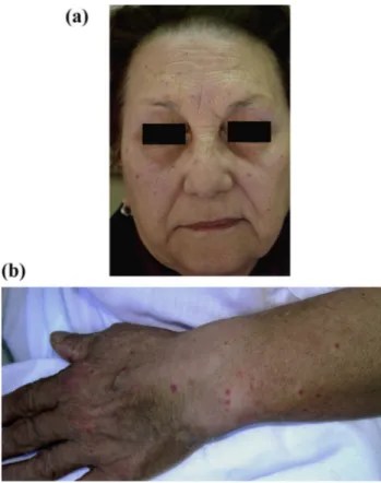Fig. 2. Epidermis was normal. Blood vessels in the superﬁcial dermis were prominent and focally dilated