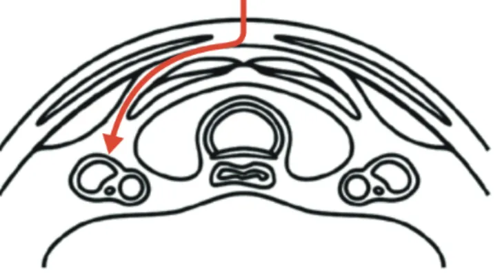 Fig. 5.  Modified lateral access to VN. Access to the VN, laterally to the strap muscle and medially to  spernocleidomuscle