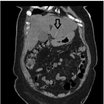 Figure 1. Abdominal CT scan showing toothpick in the liver (black arrow).