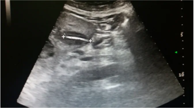 Figure 2. Ultrasonography showing hepatic abscess with a linear foreign body inside.
