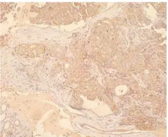 Fig.  5:  Tumor  tissue  negative,  surrounding  the  thyroid  gland 