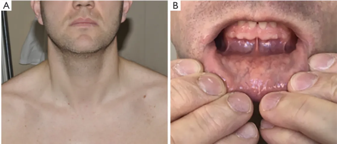 Figure 5  Postoperative outcome for TOETVA. (A) Neck cosmetic outcome at 1 week from surgery; (B) vestibular outcome after 1 month  from surgery