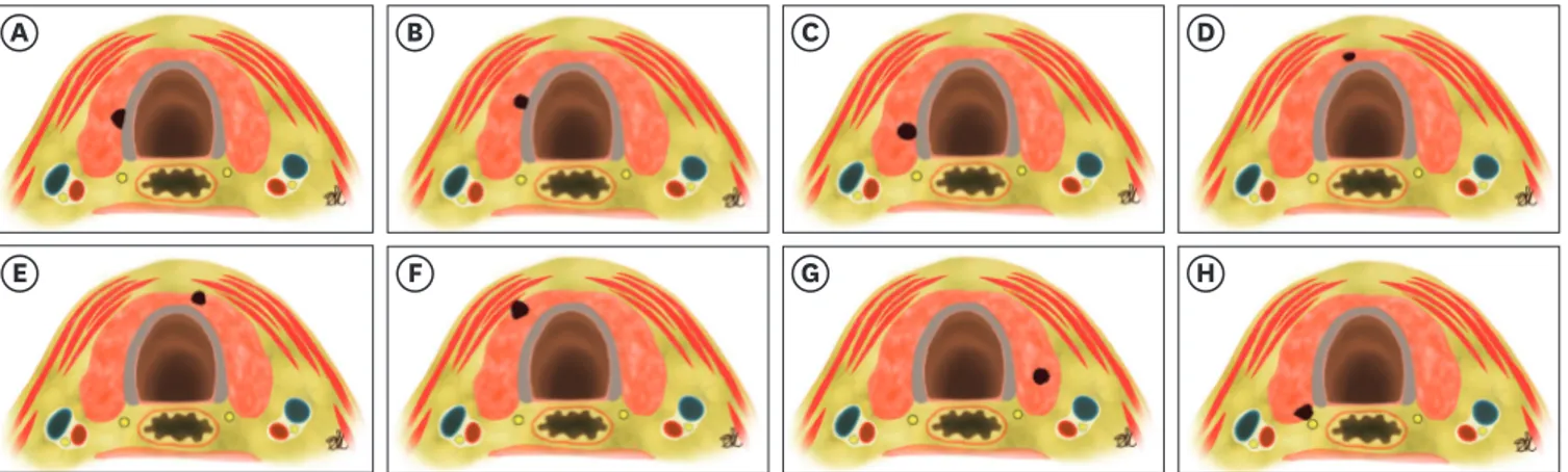 Fig. 1.  Schematic representation of the anatomical relationship between a PTMC of the thyroid gland, the tracheal wall, the RLN and strap muscles to plan the  further course of therapy (active surveillance vs