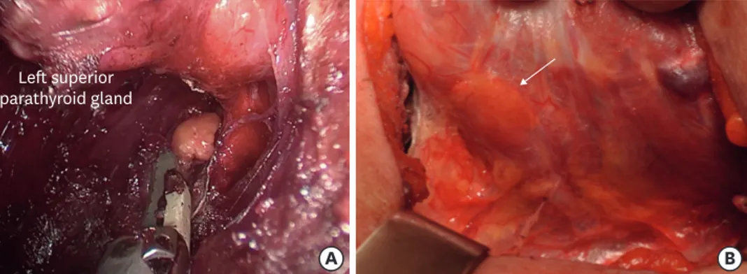 Fig. 3. Identification and preservation of parathyroid gland. (A) Transoral endoscopic thyroidectomy vestibular  approach