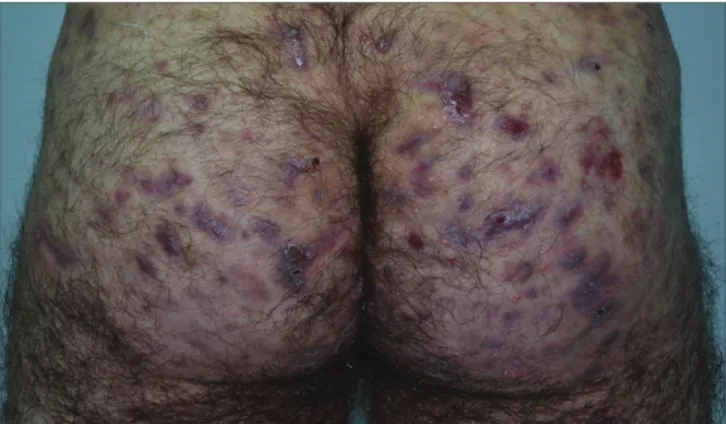Figure La: Skin lesions before photedynamie therapy