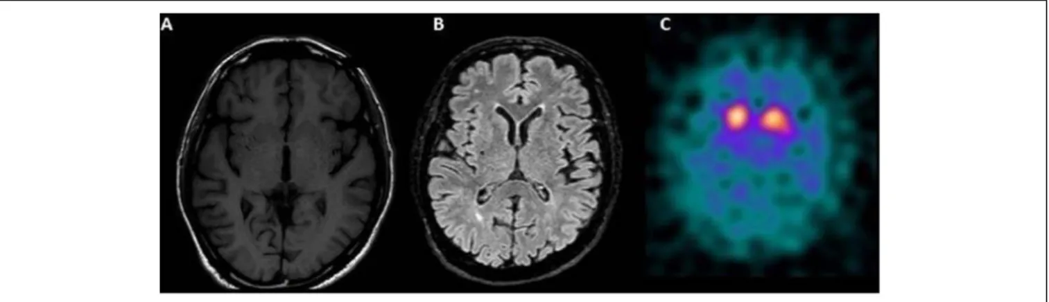 FIGURE 1 | (A) Bilateral hypointensities in T1 in the striatum, more prominent on the right side and (B) rare small subcortical white matters hyperintensities on T2 (mainly periventricular and frontal) on Magnetic Resonance Imaging of the brain