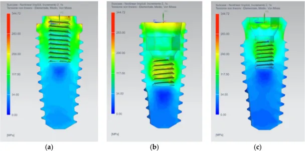 Figure 4. Equivalent Von Mises stress results on the implants: (a) AnyOne ®  External; (b) AnyOne ®
