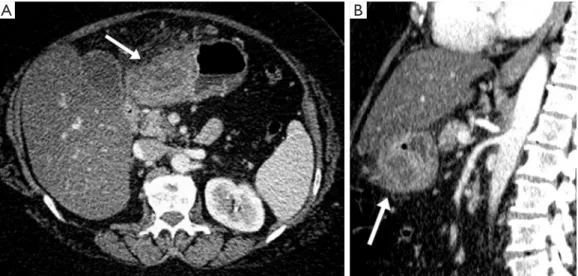 Figure 1 On transverse (A) and sagittal (B) plane, at CT imaging there was evidence the presence of a pathologic tissue between the region  of the body and gastric antrum, along the greater curvature, in the anterior wall (gray arrows)