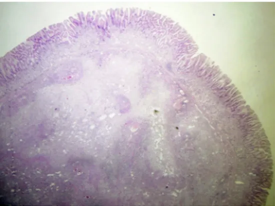 Figure 3 At higher magnification, the polyp presented mononuclear, spindle-shaped cells, arranged in whorls