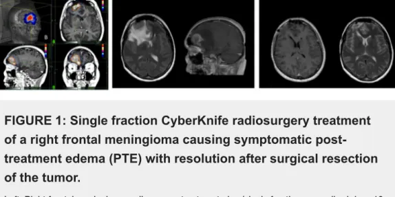 FIGURE 1: Single fraction CyberKnife radiosurgery treatment of a right frontal meningioma causing symptomatic  post-treatment edema (PTE) with resolution after surgical resection of the tumor.