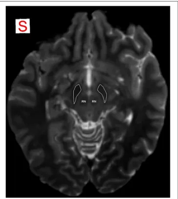 FIGURE 1 | MRI identification of SN. SN is detectable as an hypointense region in axial plane in T2-weighted images, due to T2* effect that allows a better visualization of the iron-loaded nuclei