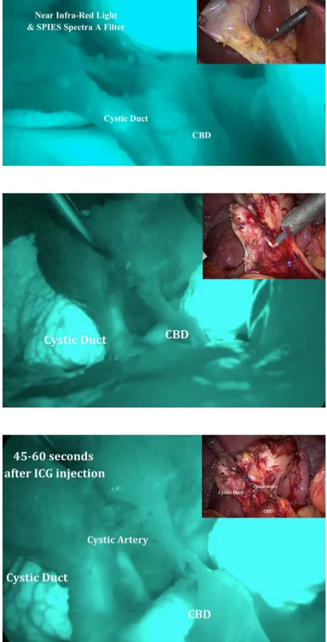 Fig. 1 Identification of the biliary anatomy during laparoscopic cholecystectomy in non-acute setting