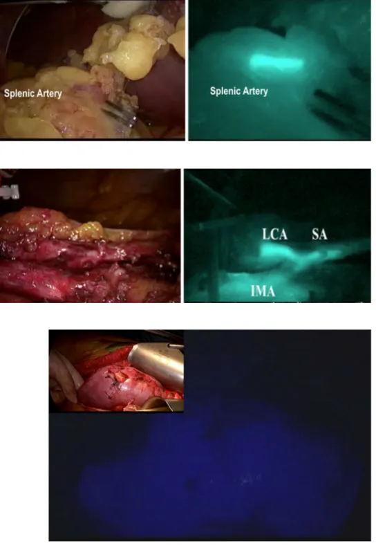 Fig. 12 Vascular anatomy study of the inferior mesenteric artery using ICG-mediated fluorescence laparoscopic treatment of type II endoleak