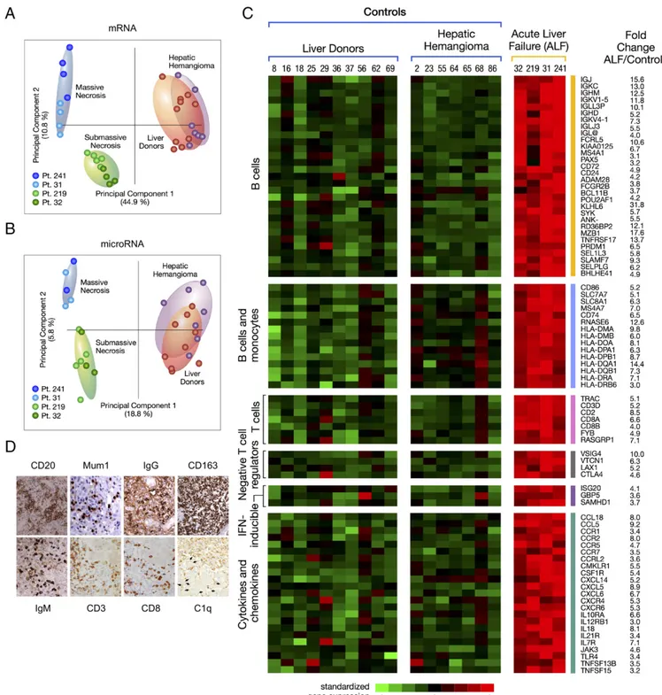 Fig. 5. Principal component analysis of mRNA and miRNA, heat map of differentially expressed immune genes, and immunohistochemistry in the liver of patients with HBV-associated ALF