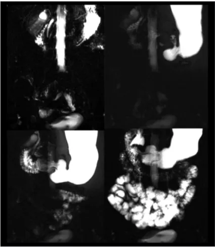 Figure 2.   MR-Fluoroscopy shows normal  progressive filling of the stomach,  duodenum and small-bowel.