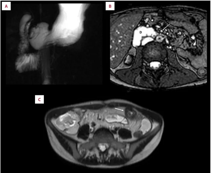 Figure 4.   MRE images in a 27-year-old CD patient with history of multiple bowel resections and intermittent postprandial epigastric  pain, vomiting, and severe malnutrition