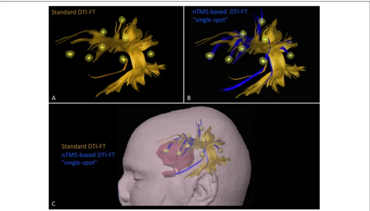 FIGURE 4 | Case example of a patient affected by a large left frontal tumor. The AF was computed by using the (A) standard and the (B) nTMS-based “single spot” DTI-FT