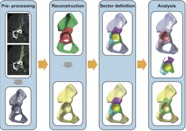 Figure 1. Workflow of the quantitative assessment. Determination of a solid model of the pelvis with bone defect on the basis of a segmented CT-data set