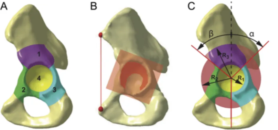 Figure 2. Bone defect sectors. (A) Defect sectors are cranial roof (1), anterior column (2), posterior column (3), and medial wall (4)