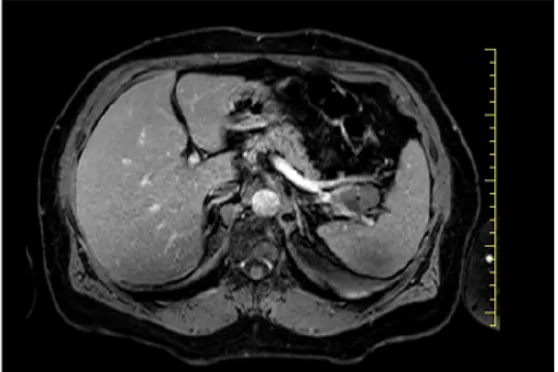 Figure 1 CT scan revealed a septate solid cystic 32 mm × 22 mm  mass in the tail of pancreas, adjacent to splenic vein and splenic  artery.