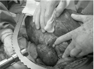 Fig. 5. Picture of the removed surgical specimen including the right kidney.