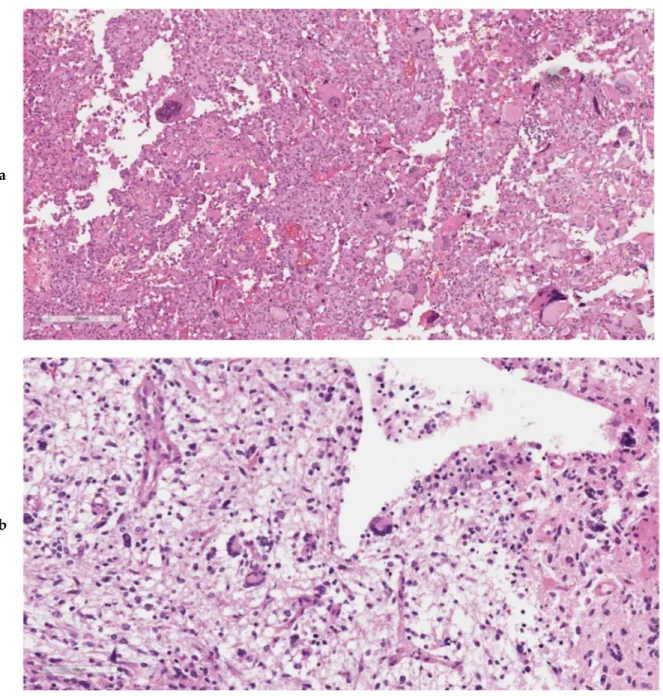 Figure 1. Histopathological aspects of ultra-mutated GBMs. Both cases 5 GL (a) and 12 GL (b) featured  neoplastic giant cells bi- or multinucleated, which were uniformly dispersed throughout the tumour  (a,b: original magnification, 200×)
