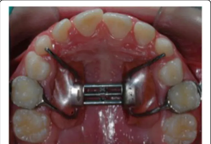 Fig. 3 Modified Haas-type expander anchored to deciduous teeth