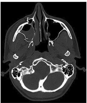 Fig. 2. Right zygomaticomaxillary complex fracture in a 39-year old Belarusian female, victim of domestic violence.