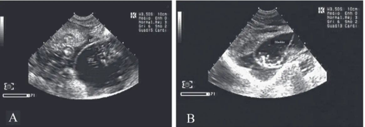 Figure 2. Intestine; normal intestinal pattern, free of  coelomic fluid