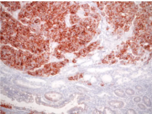 Figure 2: Intramucosal early gastric cancer with 3+ HER2 positiv- positiv-ity; adjacent intestinal metaplasia present was unstained (original magnification, ×160; Mayer’s Haemalum nuclear counterstain).