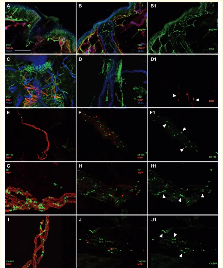 Figure 4 Severe involvement of peripheral myelinated fibres and partial disruption of Nfasc155 at the paranode in Patient 1