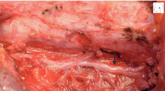 Fig. 1.  The clinical case presentation. Intraoperative evidence of first left RLN injury