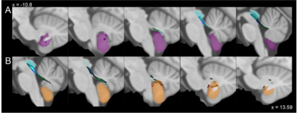 Fig. 4    Average track density  maps showing tracts connecting  cerebellar hemispheric regions  to periaqueductal grey mapped  in directionally encoded color  space (DEC) and  superim-posed to the MNI152 template