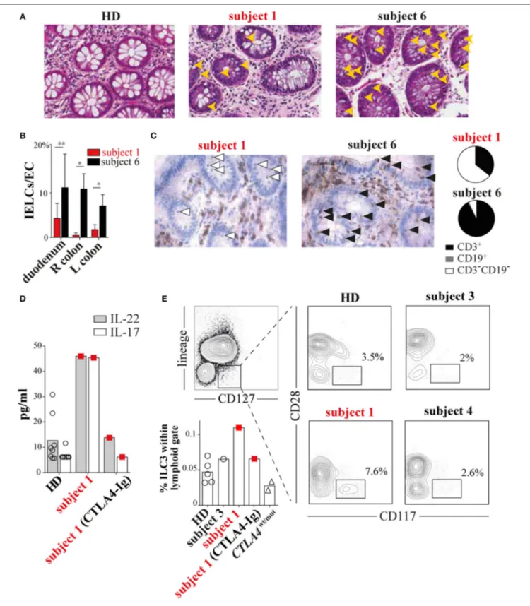 FIGURe 4 | Subject 1 displays scant T-cell gut infiltrates with increased circulating type 3 innate lymphoid cells (ILC3s) and ILC3 cytokines