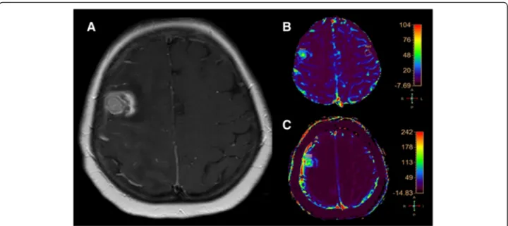 Fig. 3 a (axial SE T1-weighted after Gadolinium administration), b (rCBV colorimetric map), c (Ktrans colorimetric map)