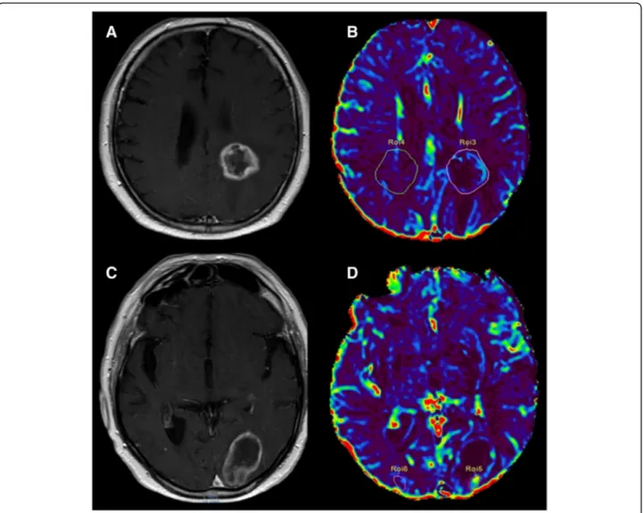 Fig. 5 a-c (axial SE T1-weighted after Gadolinium administration), b-d (rCBV colorimetric map)