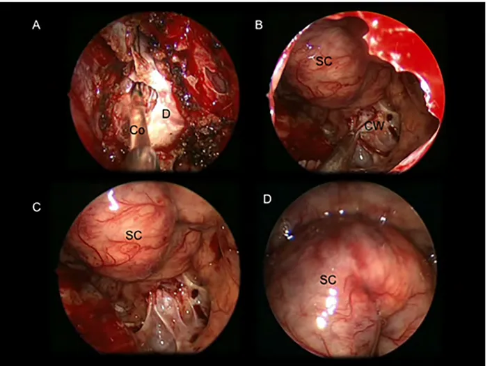 Fig 1. Intraoperative images showing an intra and suprasellar Ratkhe ’s Cleft Cyst removed via a standard endoscopic endonasalapproach