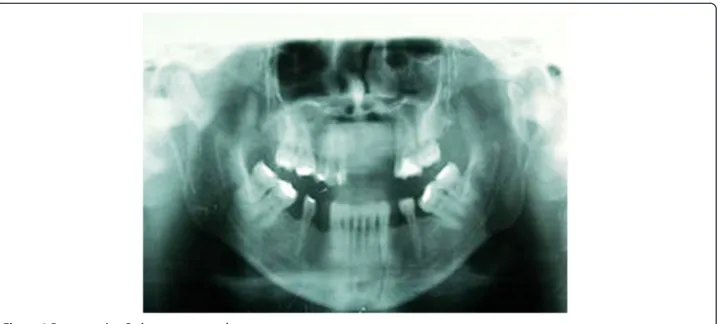 Figure 1 Pre operative Orthopantomograph.