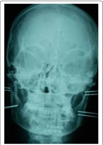 Figure 5 Post surgical CT scan.