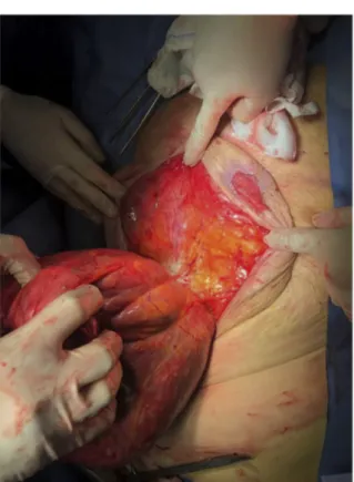 Fig. 3. Isolated paraumbilical hernia sac protruding through the abdominal wall defect.