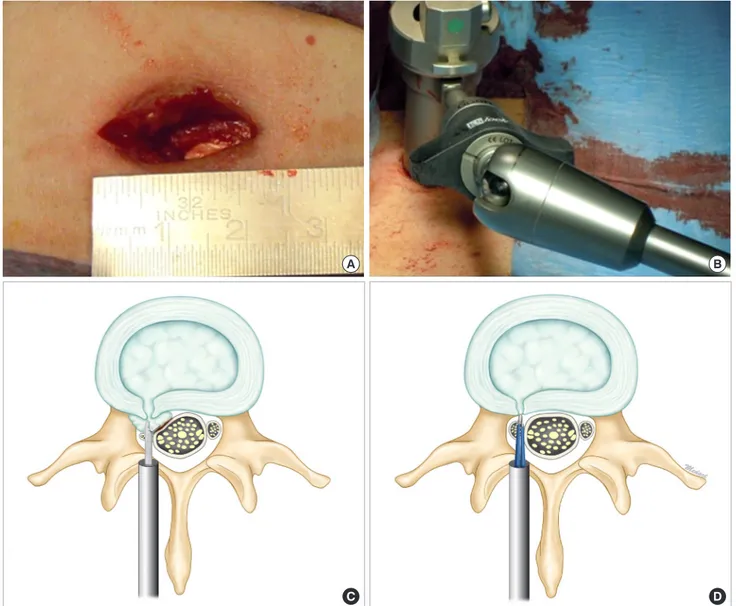 Fig. 2.  Stages of percutaneous interlaminar endoscopic sequestrectomy. (A) Limited paraspinal skin incision