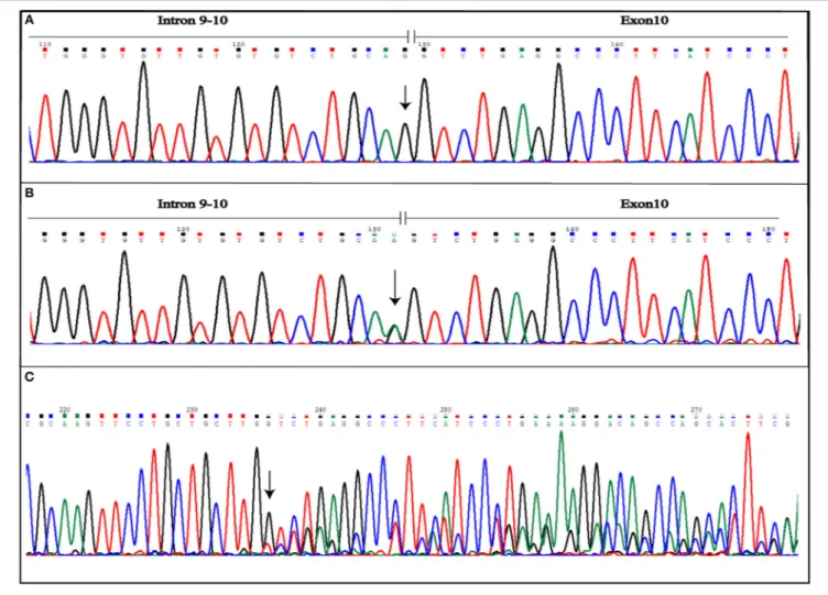 FIGURE 4 | Novel IVS10-1G&gt;A mutation detected in CCM2 gene. The figure shows both wild-type (A) and mutated (B) electropherograms