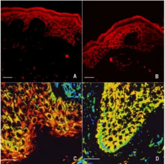 Figure 2. Inflammatory/lesional vitiligo skin: immunofluorescence staining of iNOS (A,B)