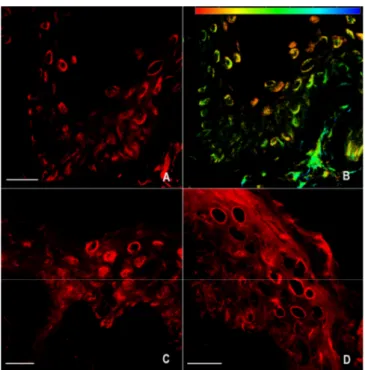 Figure 3. Inflammatory/lesional vitiligo skin: immunofluorescence staining of nNOS (A–D)