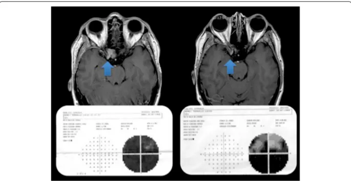 Figure 3 Left. A meningioma invading the right optic canal with optic nerve encasement causing a significant visual impairment